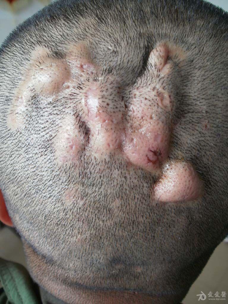 病例分享:头部脓肿性穿掘性毛囊炎,大家是如何治疗的?