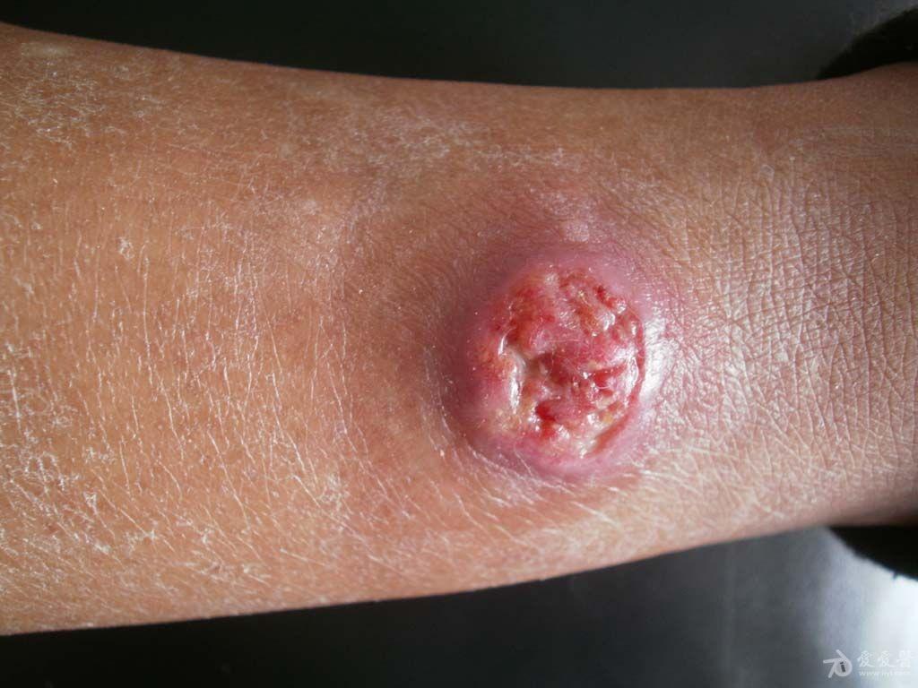 请你诊断病理结果孢子丝菌病良斑1125