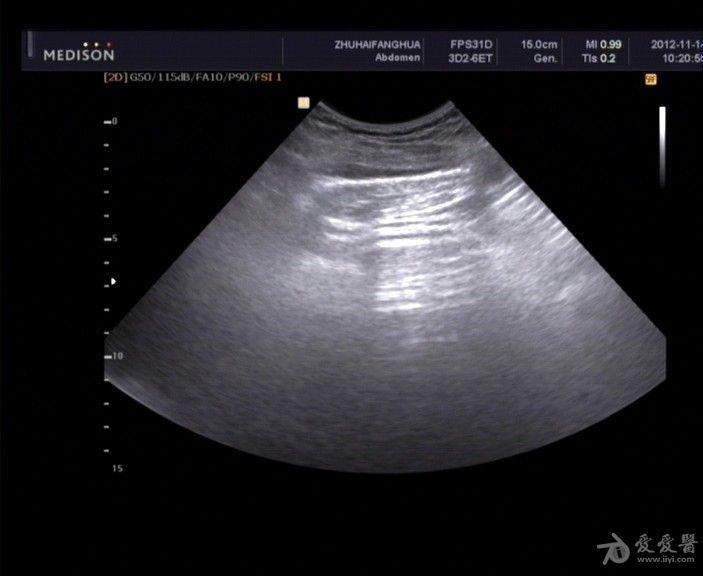 胃穿孔 - 超声医学讨论版 - 爱爱医医学论坛