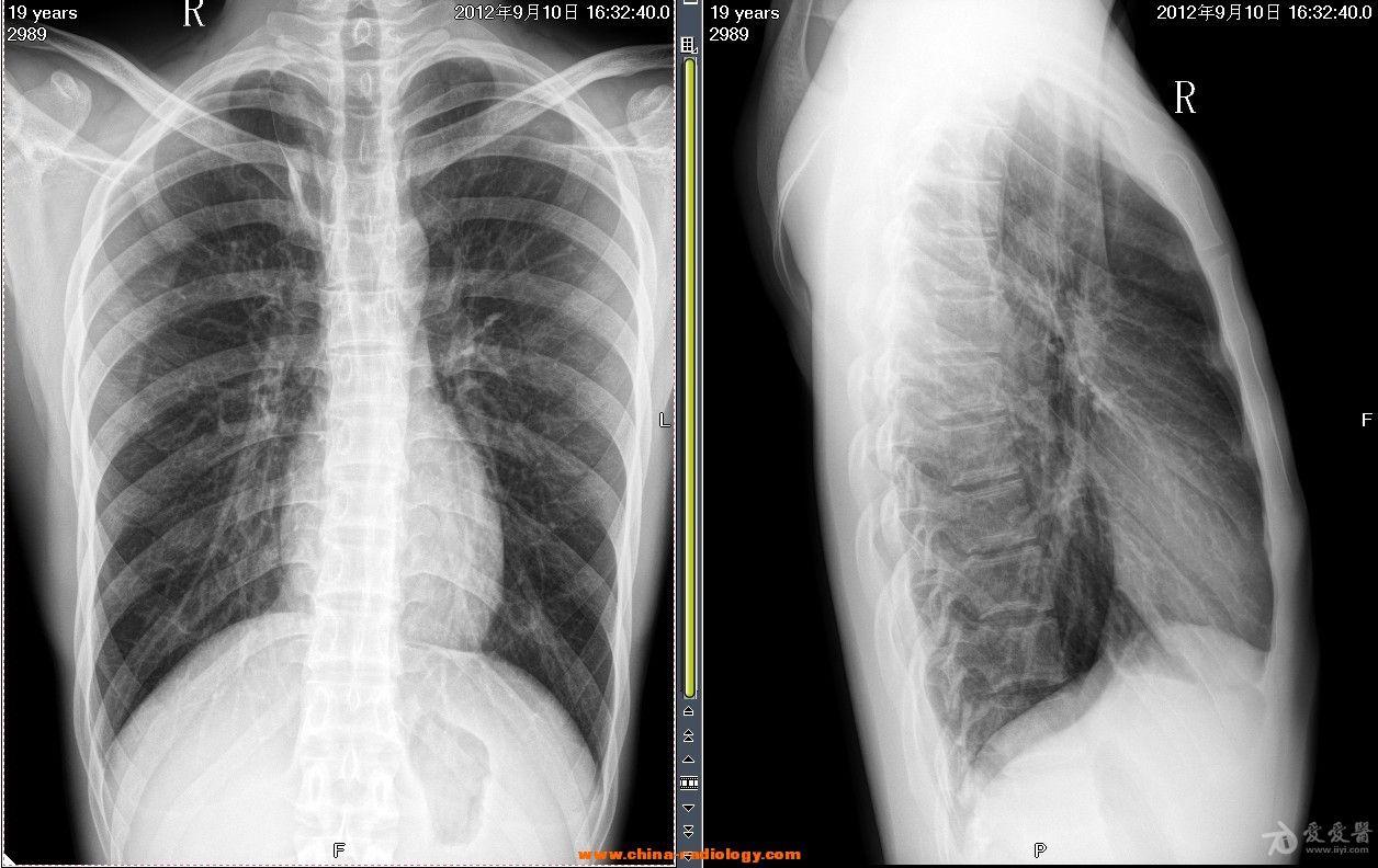 給大家看一個少見的胸片