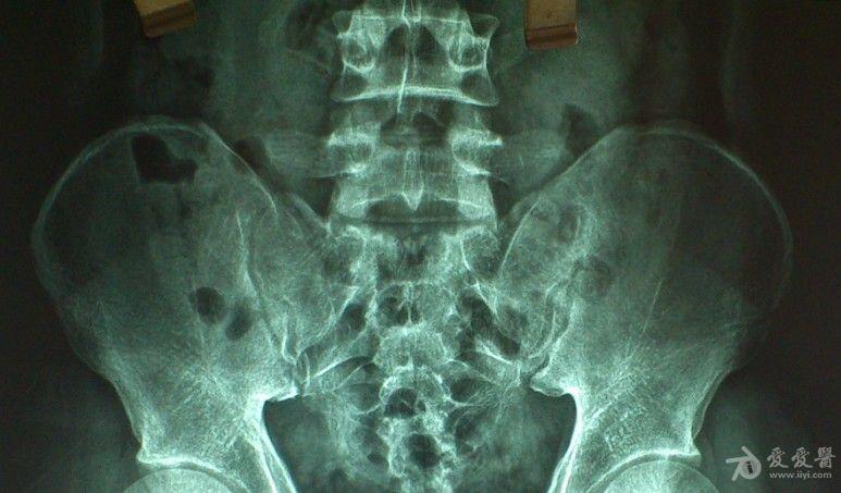 强直性脊柱炎早期图片