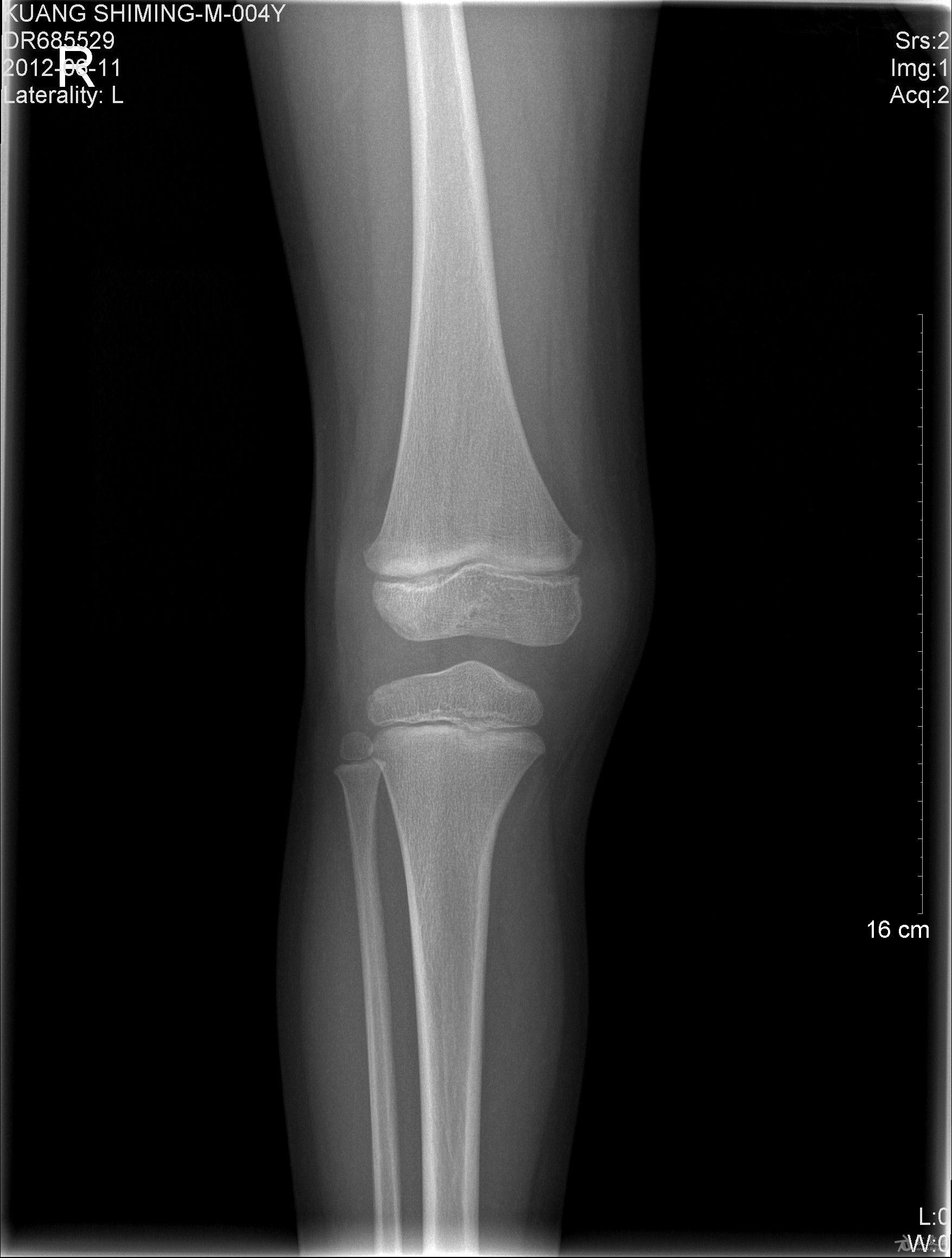 骨骺线膝盖图片