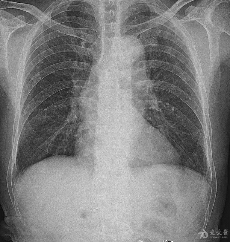 肺结核的胸片表现有哪些？
