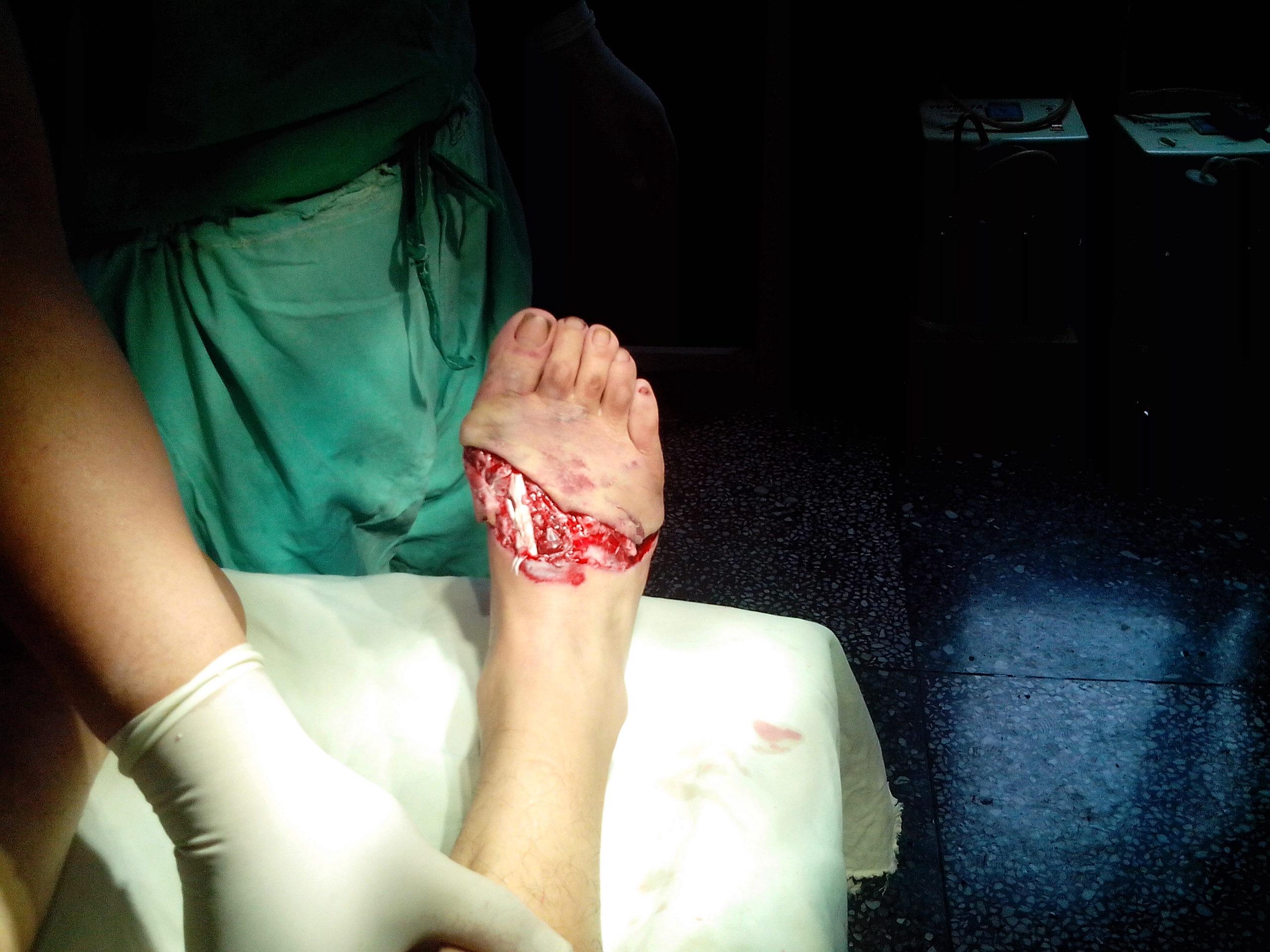 右足压砸撕脱伤一期如何处理