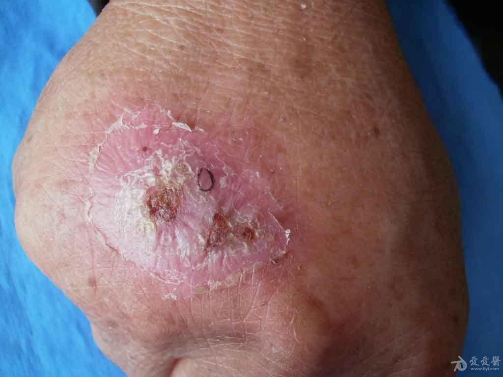 皮肤病病例分享孢子丝菌病两例