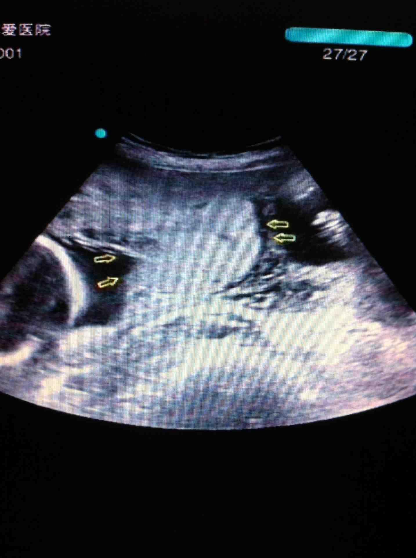 典型轮状胎盘 - 超声医学讨论版 - 爱爱医医学论坛