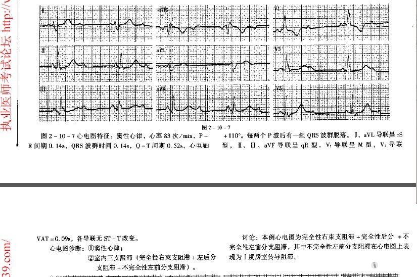 心电图简谱_正常心电图图片(2)