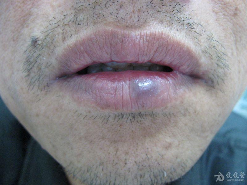 下唇癌图片图片