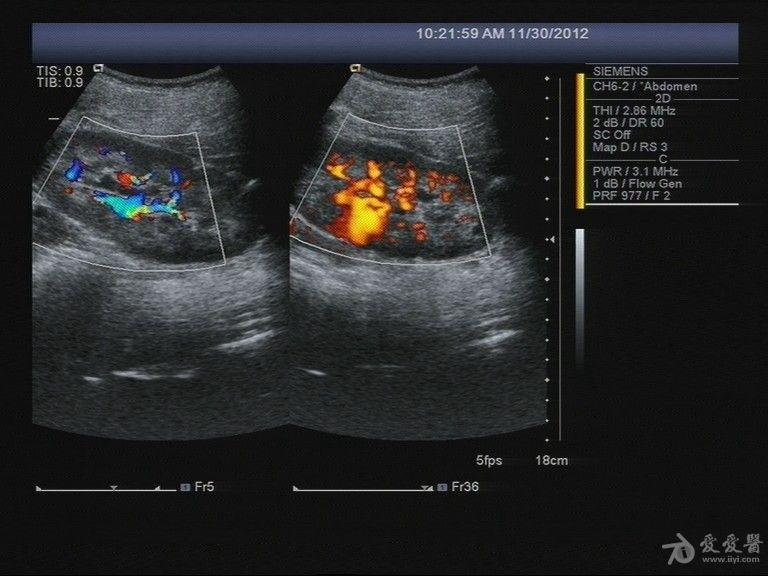 昨天碰到一例怀疑是海绵肾的病例 - 超声医学讨论版 - 爱爱医医学论坛