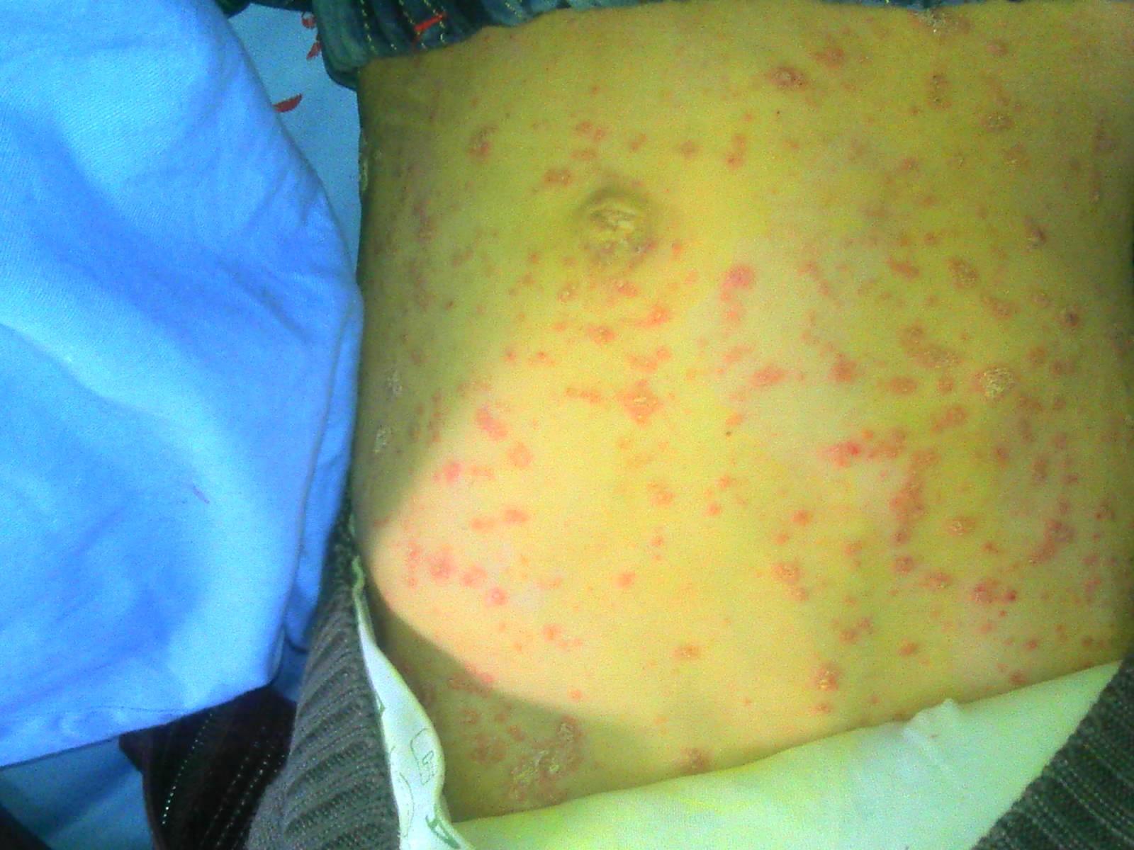 小儿皮疹,但已结痂 - 皮肤及性传播疾病讨论版 - 爱爱医医学论坛