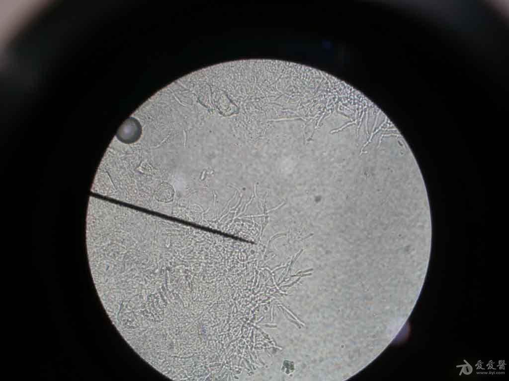 白带杂菌显微镜下图片图片
