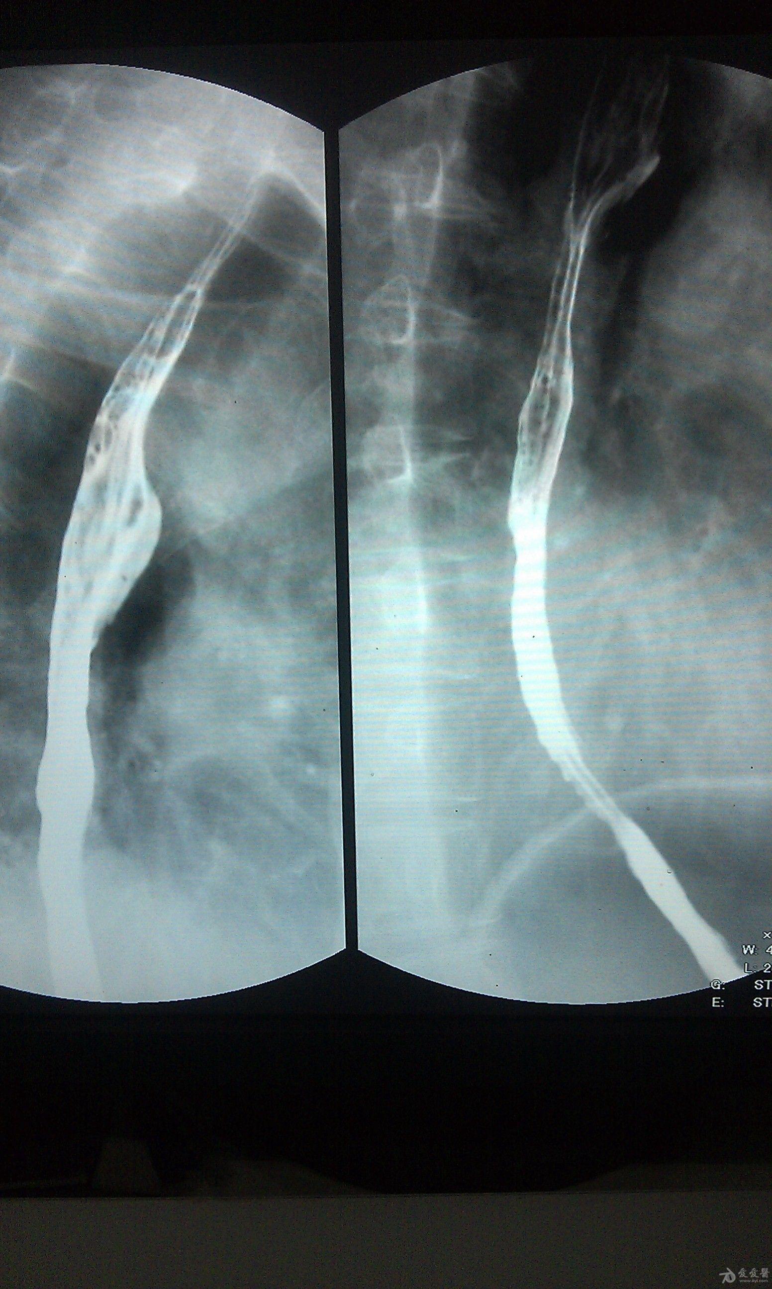 食管癌片子 - 医学影像学讨论版 - 爱爱医医学论坛