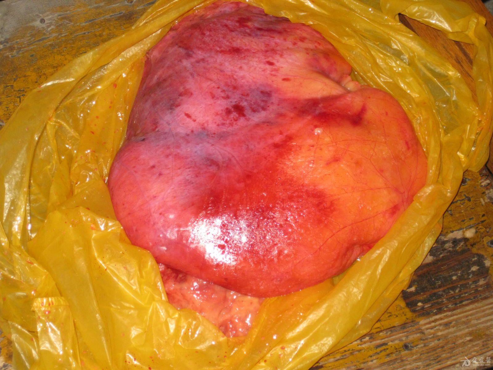 胸壁脂肪瘤图片图片