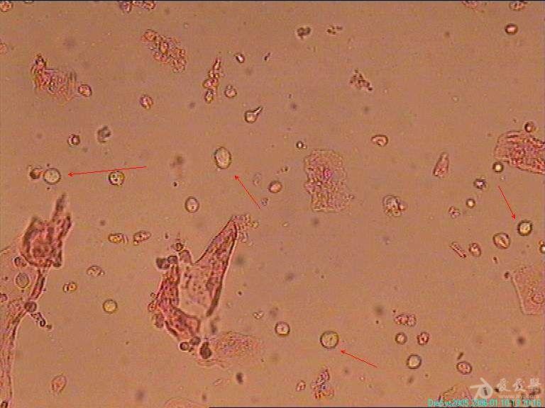 白带滴虫 显微镜图片