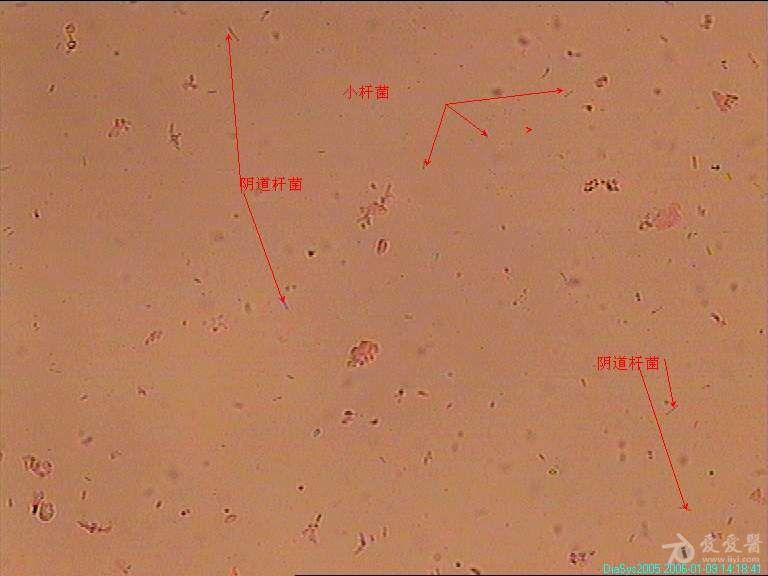 白带显微镜下杂菌图片图片