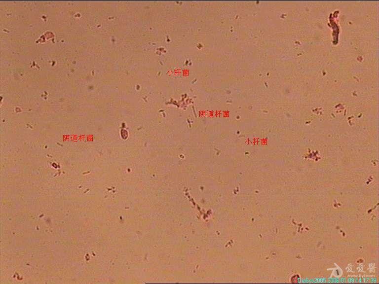 白带杂菌显微镜下图片图片
