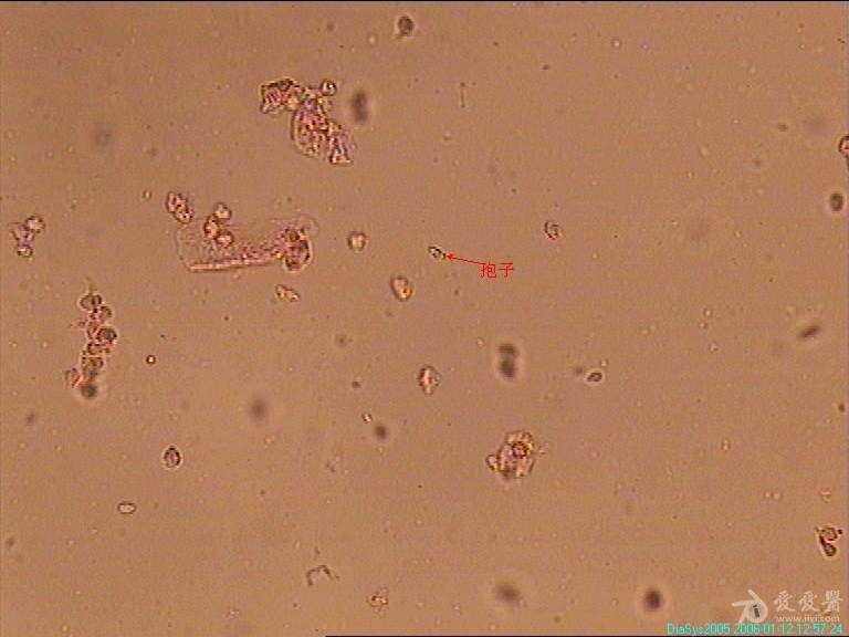 女性霉菌显微镜下图片图片