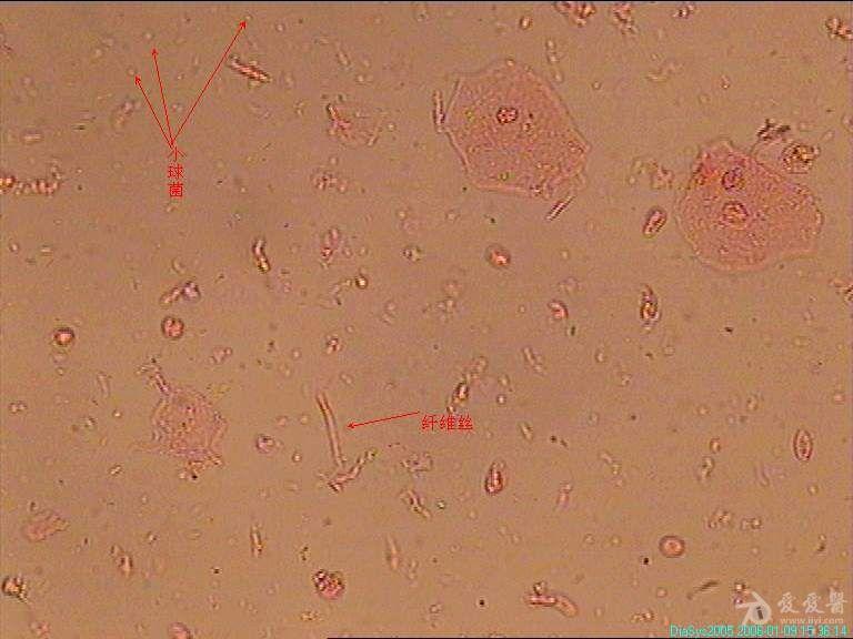 白带显微镜白细胞图片