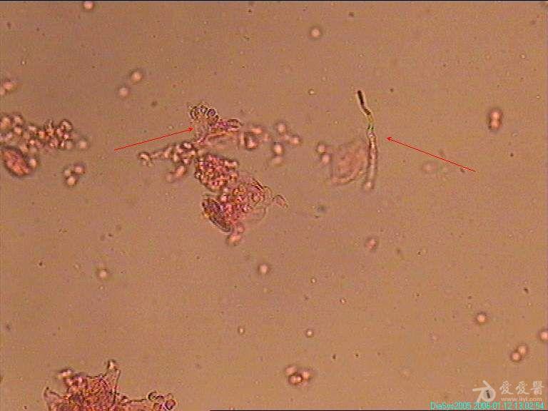 白带显微镜下杂菌图片图片