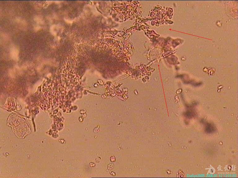 白带霉菌显微镜下图片图片