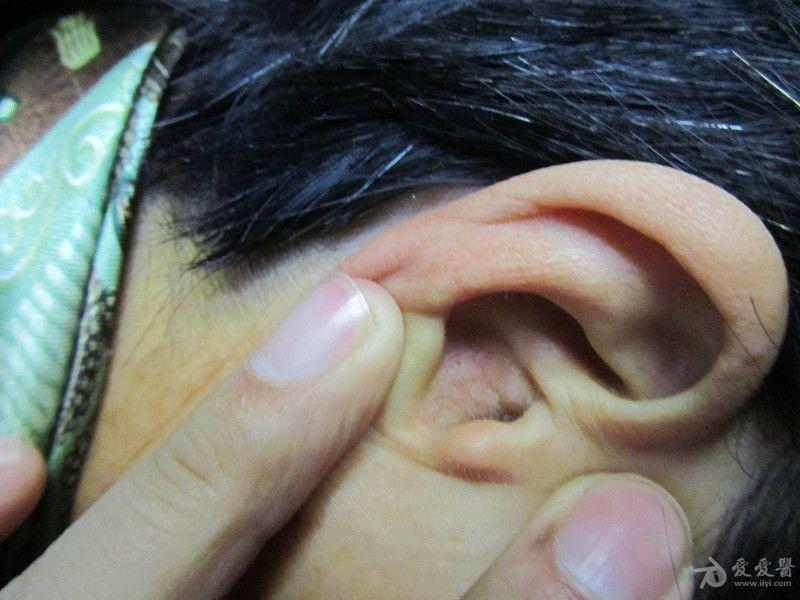 耳朵湿疹症状图片图片