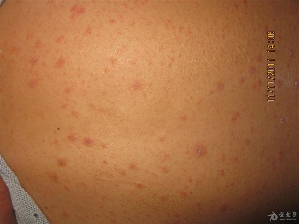 复发性玫瑰糠疹1例 - 皮肤及性传播疾病讨论版 - 爱爱医医学论坛