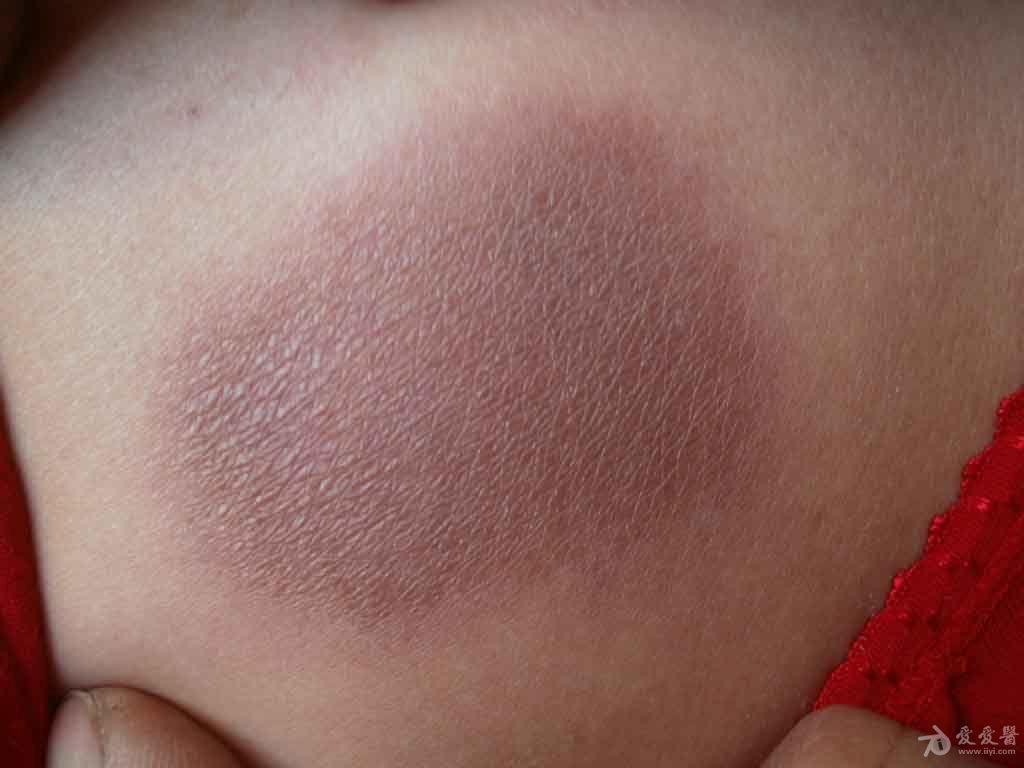 典型病例分享固定药疹