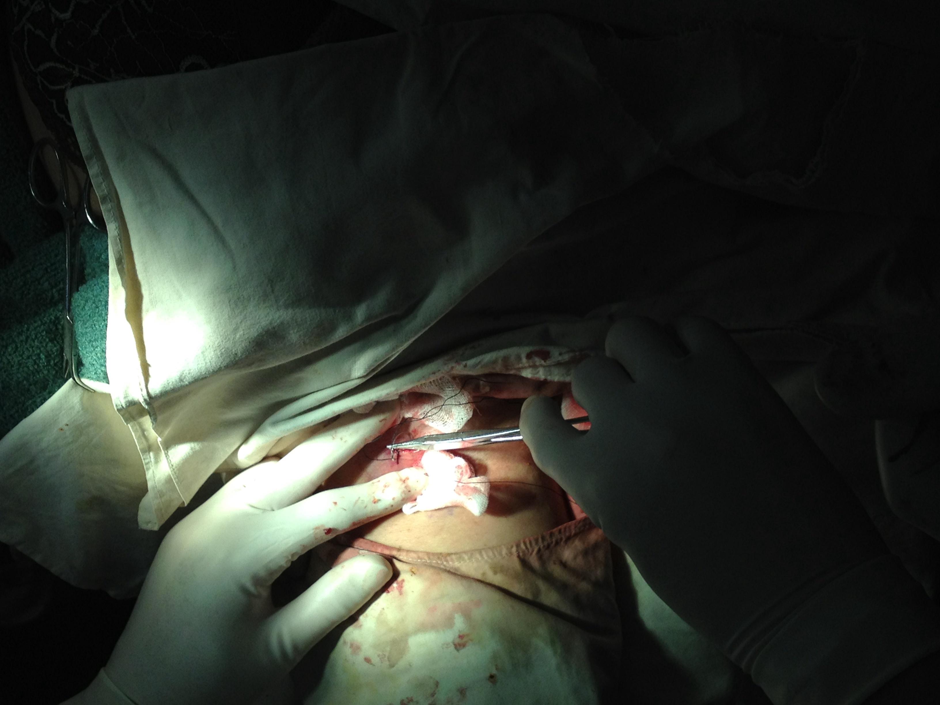 小切口皮瓣修剪法治疗腋臭