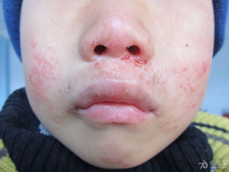 患儿面部的皮损面部湿疹