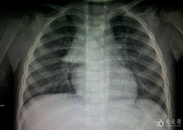 小孩正常胸腺——【船帆征】