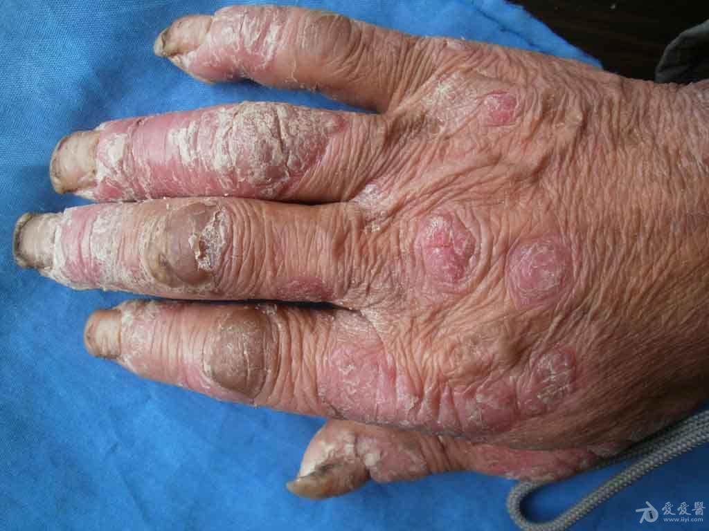 典型病例分享银屑病
