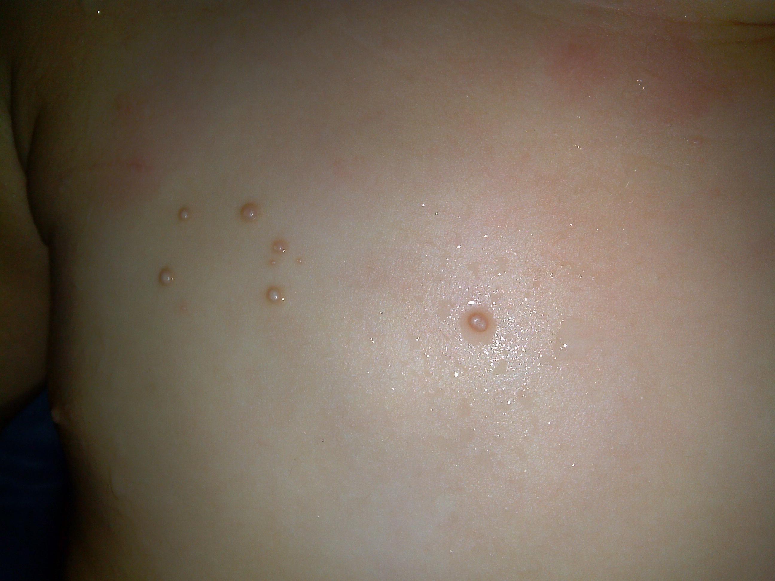 病毒性软疣初期的图片图片