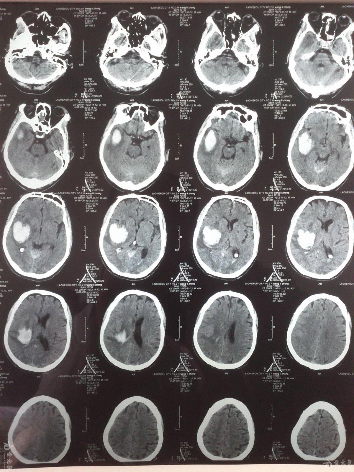 腦出血二進宮一例