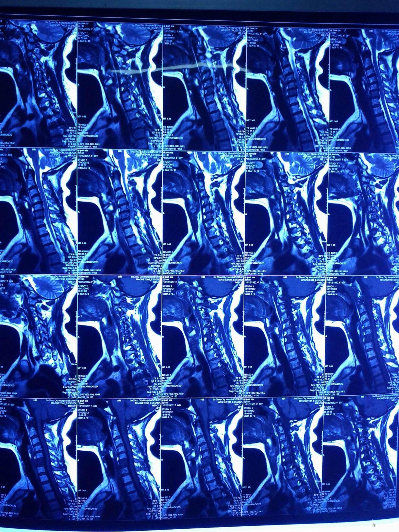 mri第六椎体血管瘤请大家分析