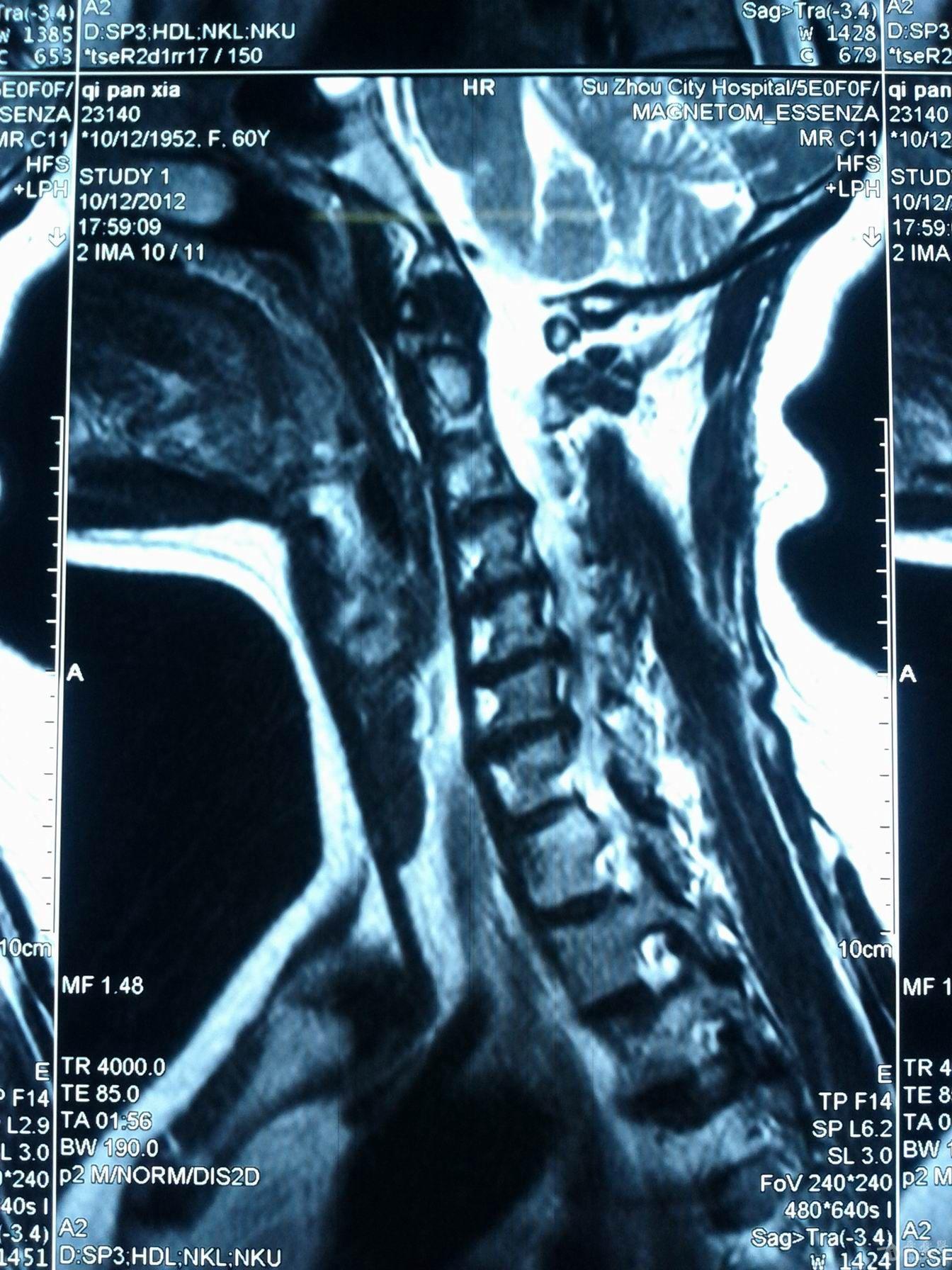 椎管内血管瘤图片
