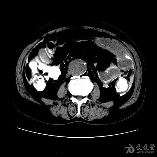 結腸癌鋇灌腸後腸穿孔手術結果已公佈20121219