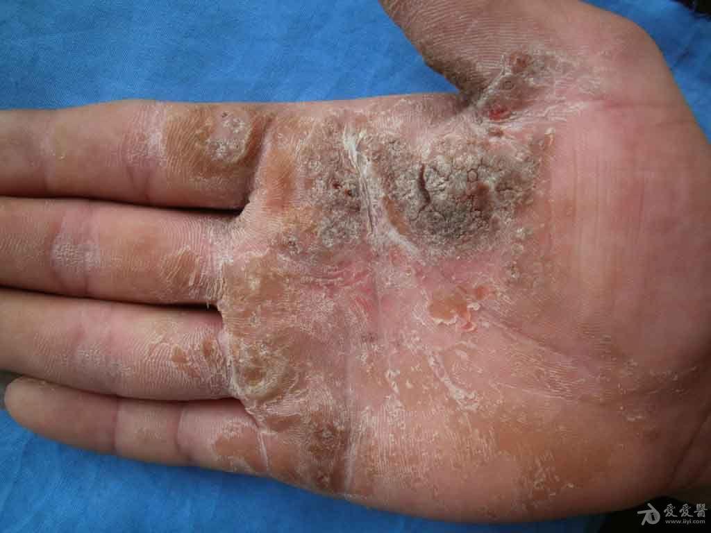 皮肤及性传播疾病讨论版 - 爱爱医医学论坛