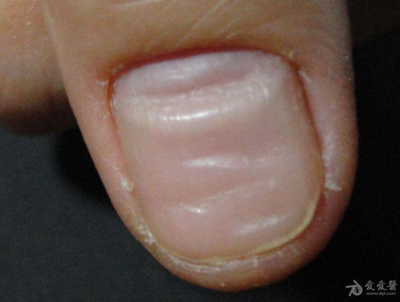 请高人给解释一下大手母指甲纹是怎么回事