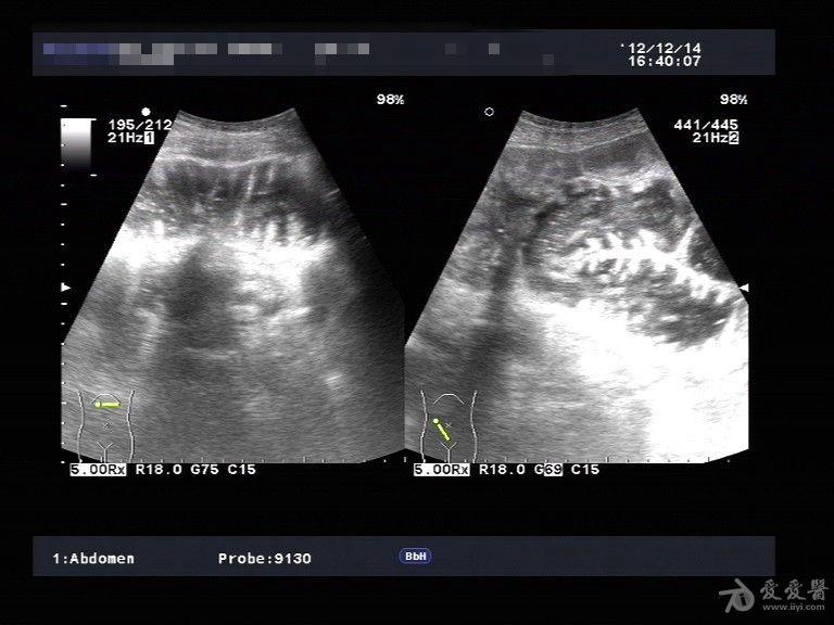 视觉冲击肠梗阻