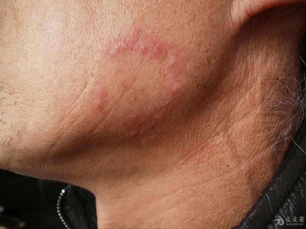 典型病例分享面癣