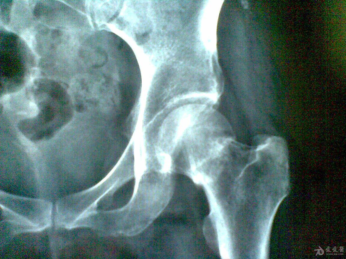 股骨颈骨折保守图片