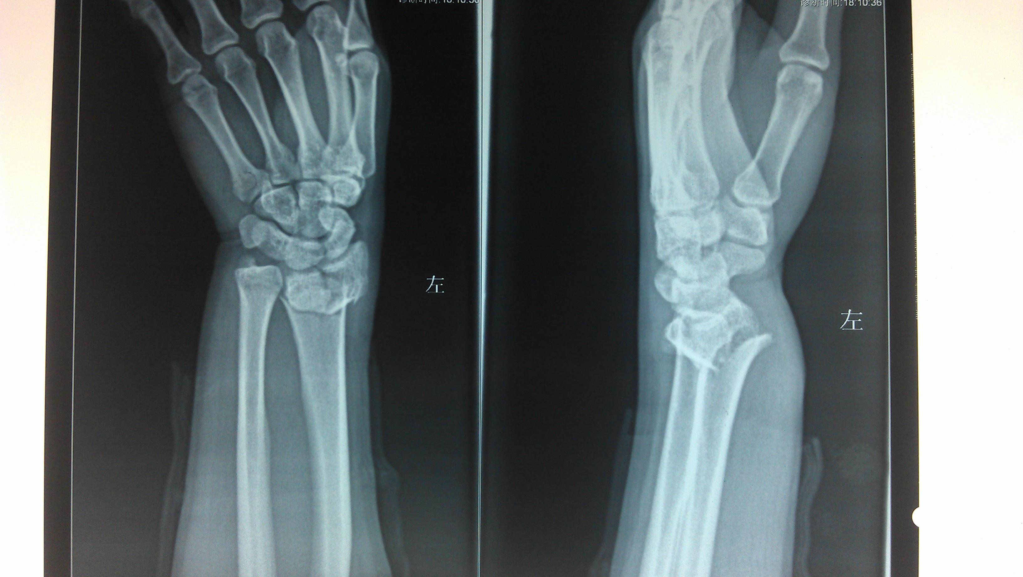 右桡骨远端骨折图片