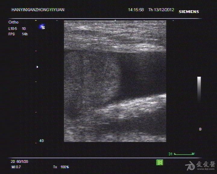 腹股沟疝合并膀胱疝出