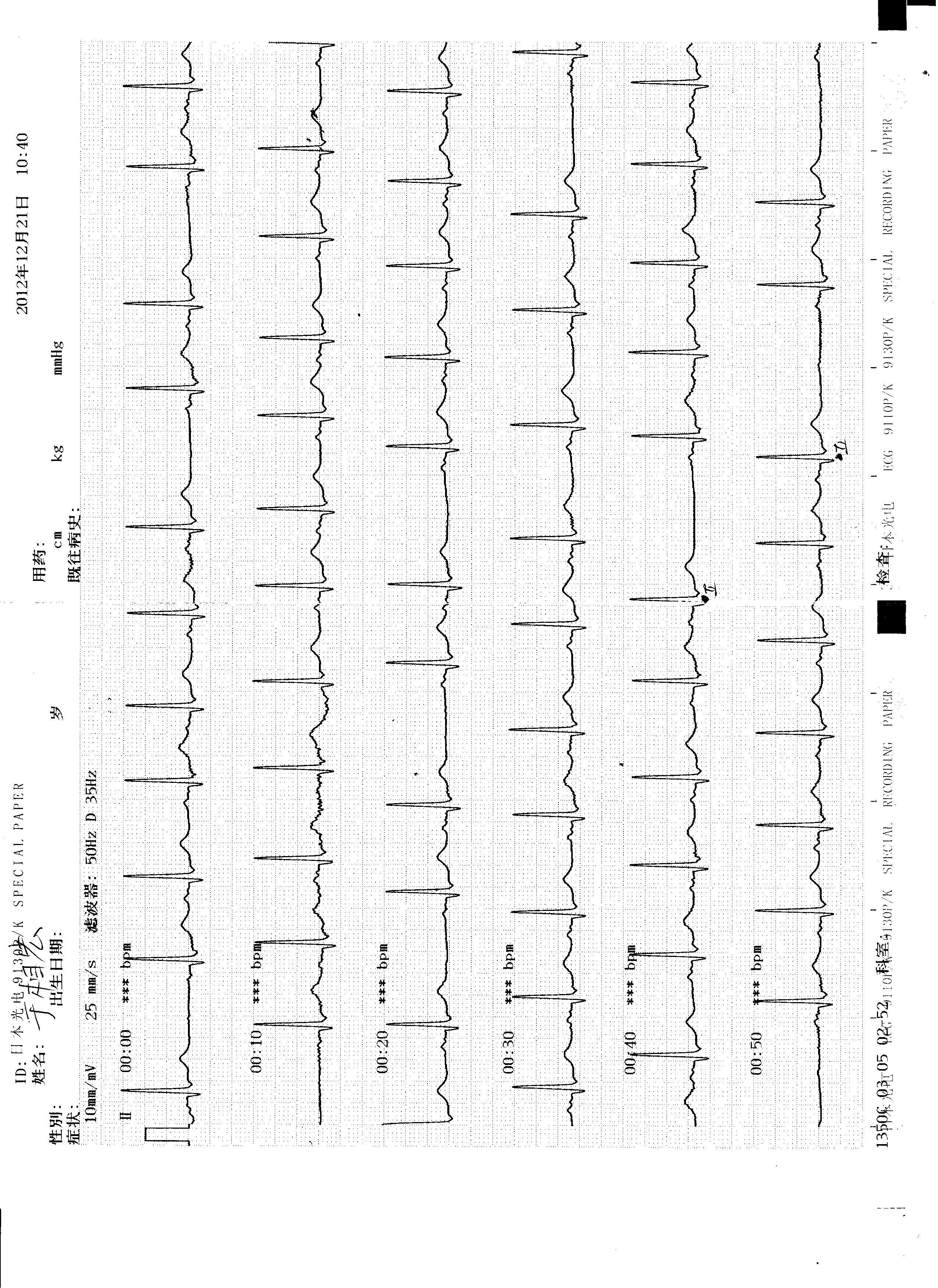 急 传了12导联图 - 心电图脑电图专业讨论版 - 爱爱医医学论坛
