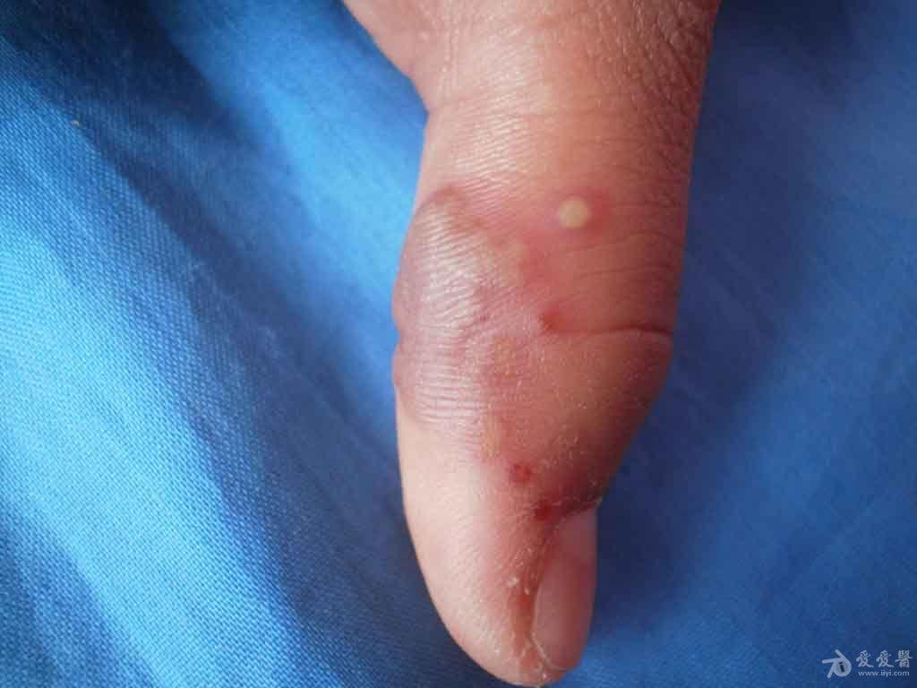 典型病例分享手指单纯疱疹