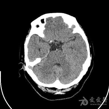 鞍区高密度结节