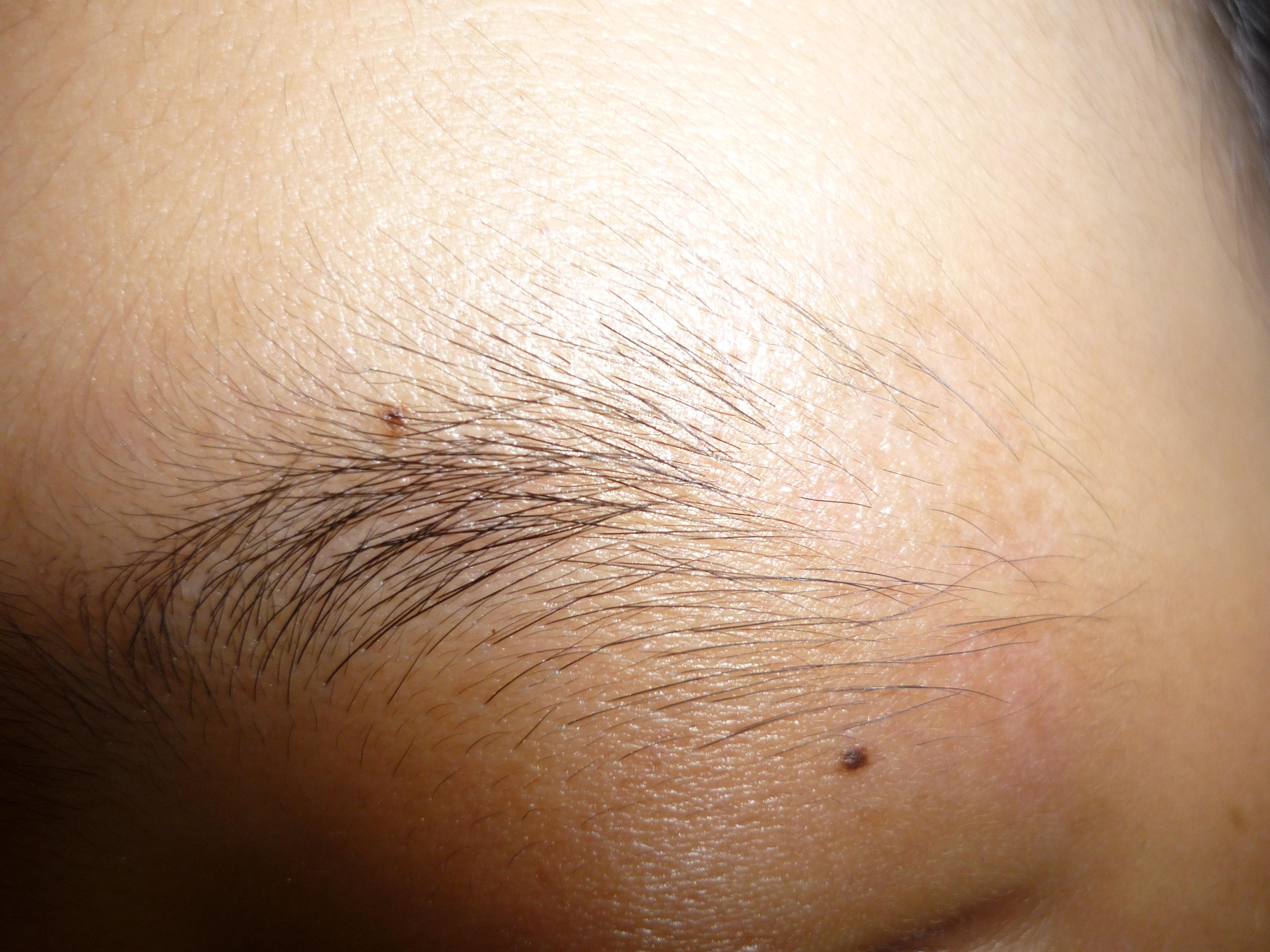 典型病例——眉毛脱落症