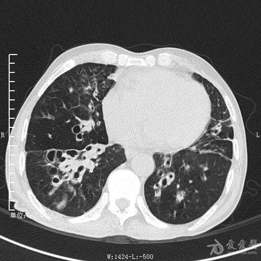 典型支氣管擴張及肺水腫ct片