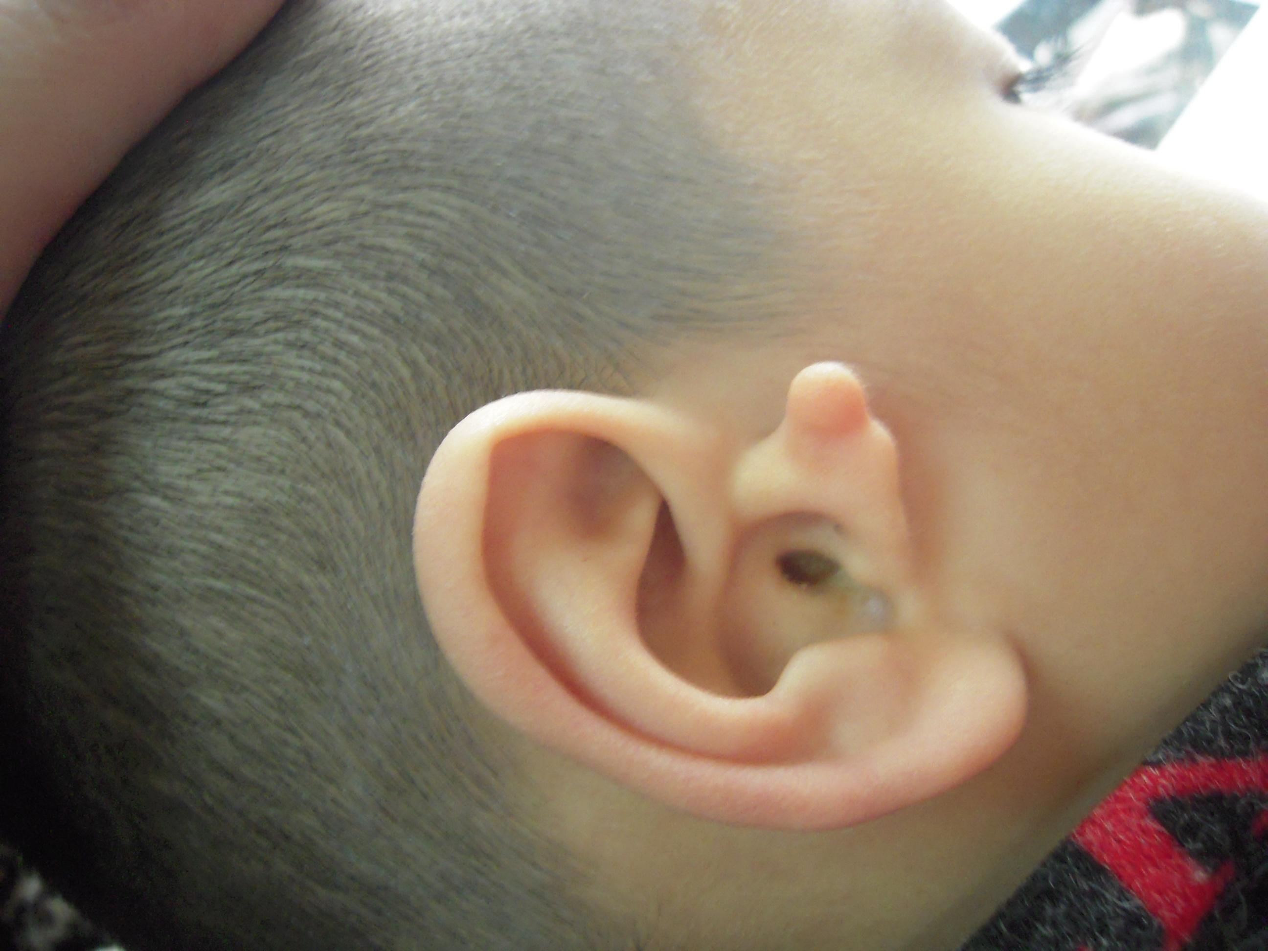 唐氏宝宝的特征耳朵图片