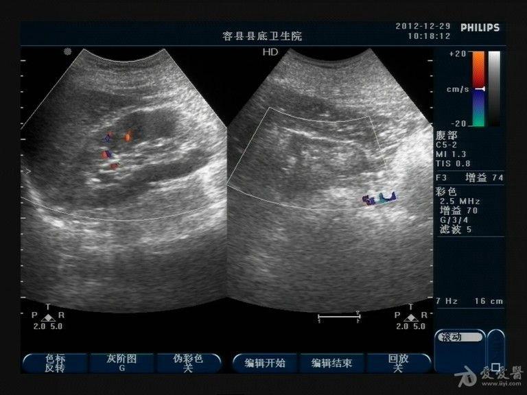 海绵肾超声表现及图片图片